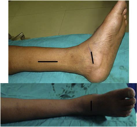 This develops when the <strong>posterior tibial tendon</strong> stretches and becomes. . Posterior tibial tendon transfer surgery recovery